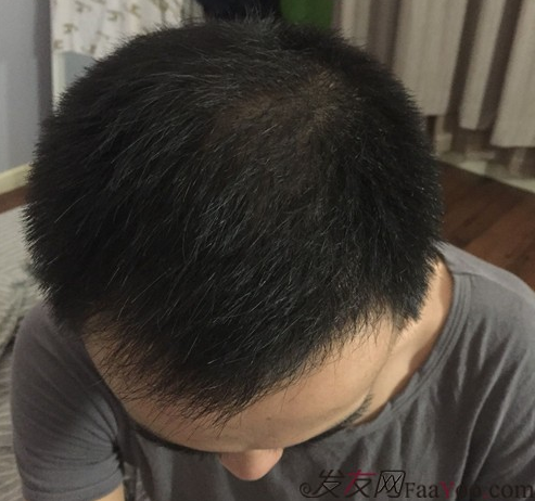 長沙大麥微針植發(fā)3510單位，一步步變帥的過程