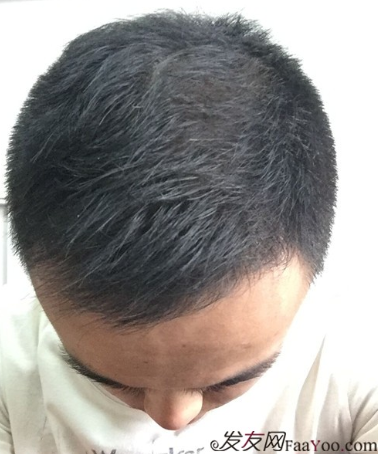 長沙大麥微針植發(fā)3510單位，一步步變帥的過程