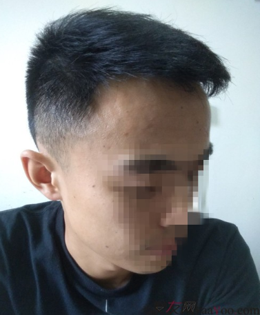 長沙大麥微針植發(fā)3510單位，一步步變帥的過程