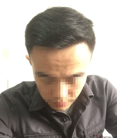 長沙大麥微針植發(fā)3510單位，一步步變帥的過程