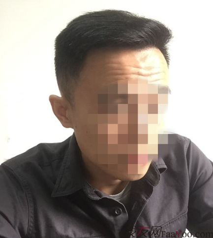 長沙大麥微針植發(fā)3510單位，一步步變帥的過程