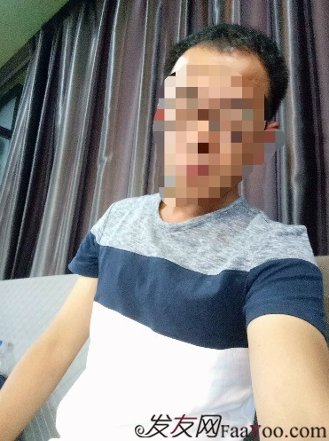 我在青島大麥微針植了發(fā)，3600單位期待我的蛻變