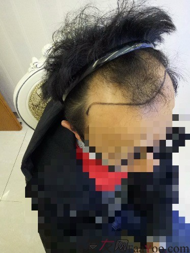 我在青島大麥微針植了發(fā)，3600單位期待我的蛻變