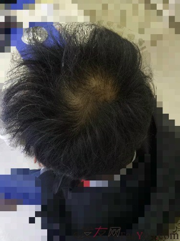 我在青島大麥微針植了發(fā)，3600單位期待我的蛻變