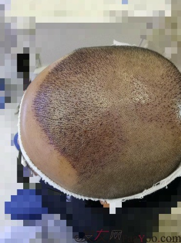 我在青島大麥微針植了發(fā)，3600單位期待我的蛻變