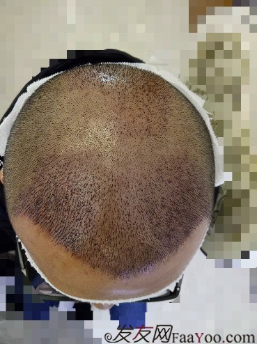 我在青島大麥微針植了發(fā)，3600單位期待我的蛻變