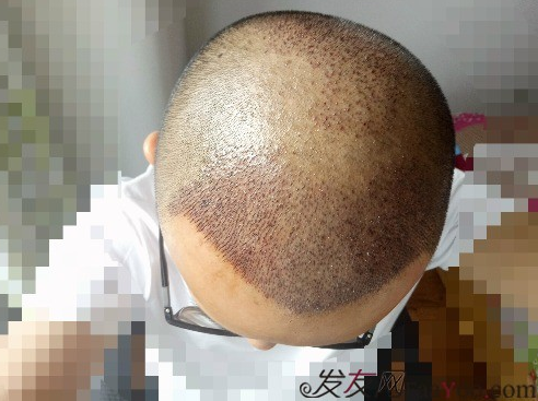 我在青島大麥微針植了發(fā)，3600單位期待我的蛻變