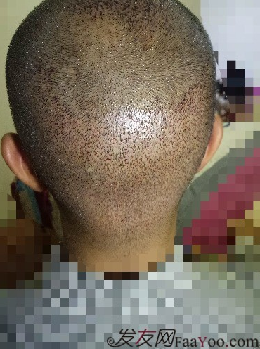 我在青島大麥微針植了發(fā)，3600單位期待我的蛻變