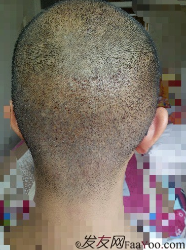 我在青島大麥微針植了發(fā)，3600單位期待我的蛻變