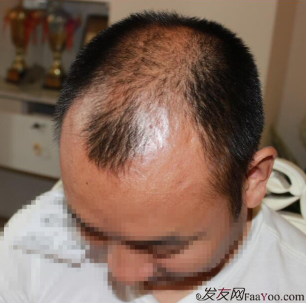 5級脫發(fā)植發(fā)經(jīng)歷，選來選去最終還是成都大麥微針給了我自信