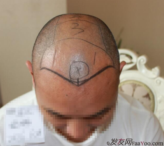 5級脫發(fā)植發(fā)經(jīng)歷，選來選去最終還是成都大麥微針給了我自信