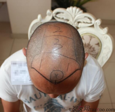 5級脫發(fā)植發(fā)經(jīng)歷，選來選去最終還是成都大麥微針給了我自信