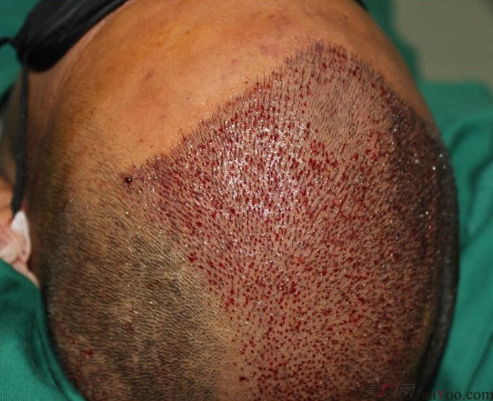 5級脫發(fā)植發(fā)經(jīng)歷，選來選去最終還是成都大麥微針給了我自信