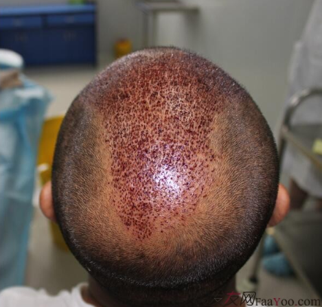 5級脫發(fā)植發(fā)經(jīng)歷，選來選去最終還是成都大麥微針給了我自信