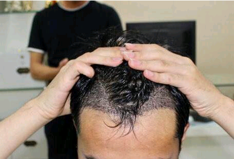 植發(fā)價格表（2021年最新）