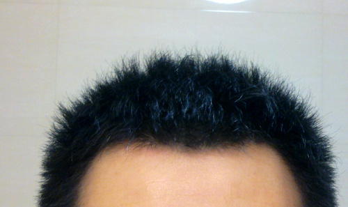 1000個毛囊單位植發(fā)的價格