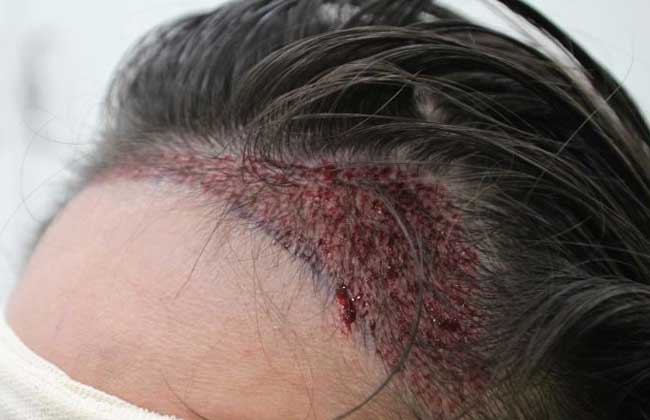 2000個毛囊單位植發(fā)的價格