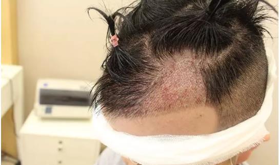 3000個毛囊單位植發(fā)的價格