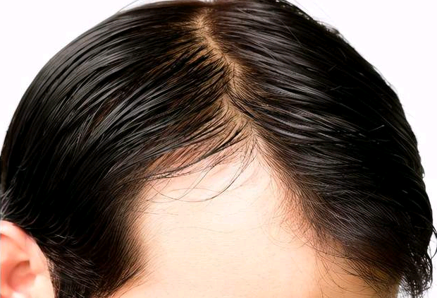 5000個毛囊單位植發(fā)的價格