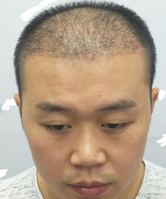 重慶頭頂大面積植發(fā)，看五個(gè)月后的效果我滿(mǎn)意了