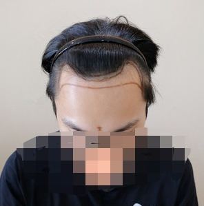 重慶發(fā)際線植發(fā)，改善大額頭的秘訣，來看看改變