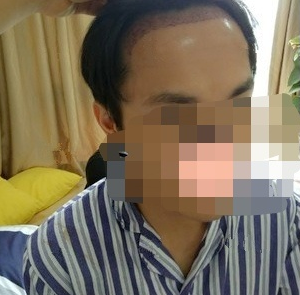 重慶發(fā)際線植發(fā)，改善大額頭的秘訣，來看看改變