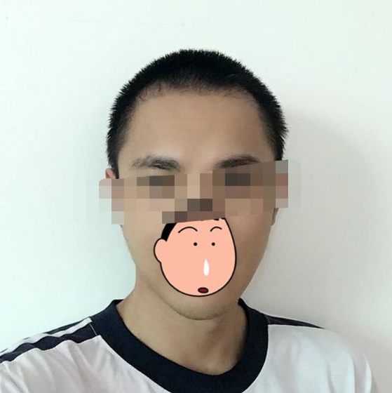 重慶發(fā)際線植發(fā)，改善大額頭的秘訣，來看看改變