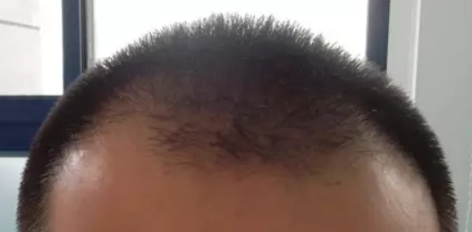 陪弟弟在河北植發(fā)，半年后我向大家分享一下他的植發(fā)過程