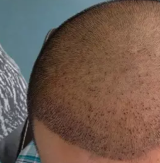 陪弟弟在河北植發(fā)，半年后我向大家分享一下他的植發(fā)過程