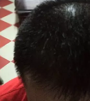 陪弟弟在河北植發(fā)，半年后我向大家分享一下他的植發(fā)過程