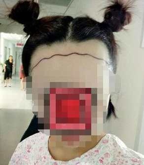 美女石家莊植發(fā)案例前后對比圖，這變化真的不一樣