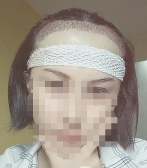 美女石家莊植發(fā)案例前后對比圖，這變化真的不一樣