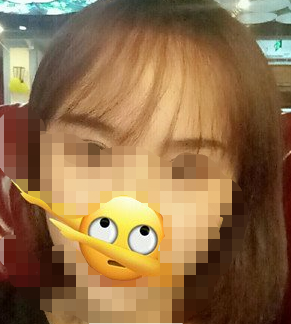 美女石家莊植發(fā)案例前后對比圖，這變化真的不一樣