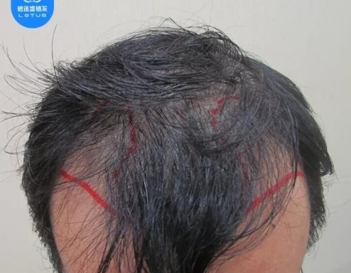 山西太原碧蓮盛植發(fā)2000單位，九個月后的效果真是不一樣