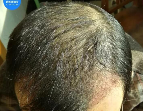 山西太原碧蓮盛植發(fā)2000單位，九個月后的效果真是不一樣