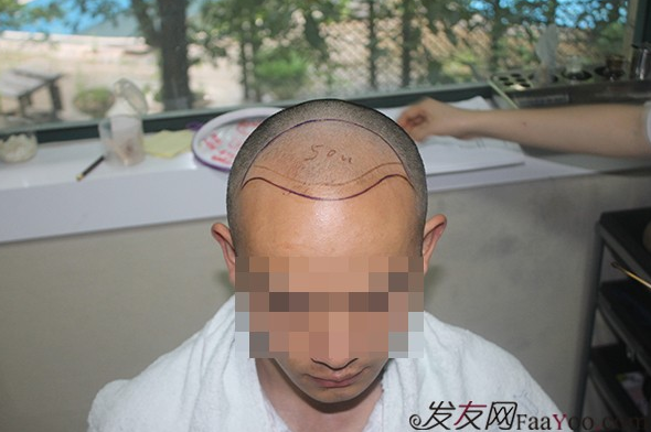 石家莊雍禾植發(fā)2640毛囊單位，技術(shù)真的很好