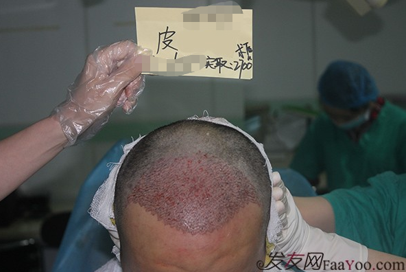 石家莊雍禾植發(fā)2640毛囊單位，技術(shù)真的很好