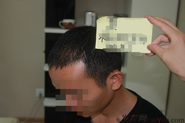 石家莊雍禾植發(fā)2640毛囊單位，技術(shù)真的很好