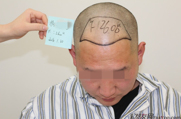 鄭州雍禾植發(fā)后七天，2600單位還是值得信任的