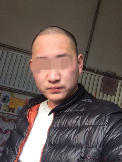 鄭州雍禾植發(fā)后七天，2600單位還是值得信任的