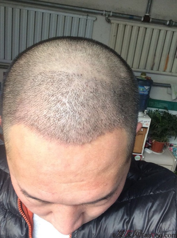 鄭州雍禾植發(fā)后七天，2600單位還是值得信任的