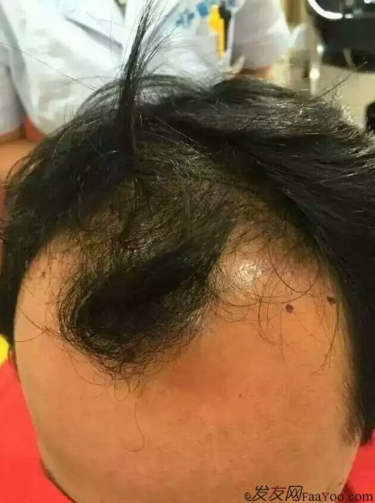 來到南寧雍禾植發(fā)3600單位，我也要光鮮亮麗的站在陽光下