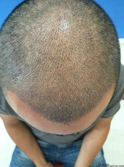 來到南寧雍禾植發(fā)3600單位，我也要光鮮亮麗的站在陽光下