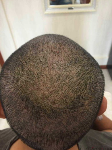 來到南寧雍禾植發(fā)3600單位，我也要光鮮亮麗的站在陽光下