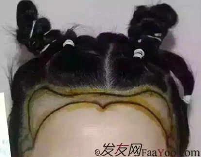 北京真實案例告訴你植發(fā)效果怎么樣？看看一年后的效果