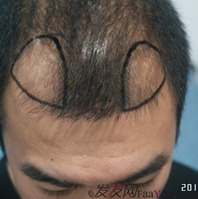 來山東青島植發(fā)2200毛囊單位，終于對(duì)我的發(fā)際線滿意了
