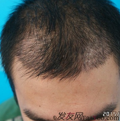 來山東青島植發(fā)2200毛囊單位，終于對(duì)我的發(fā)際線滿意了