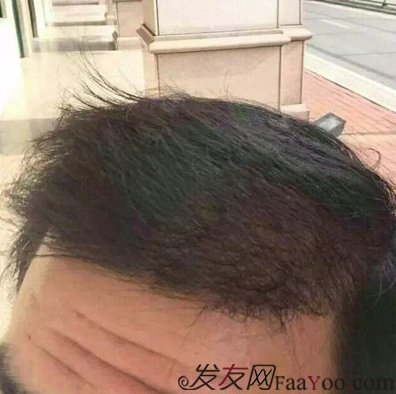 來山東青島植發(fā)2200毛囊單位，終于對(duì)我的發(fā)際線滿意了