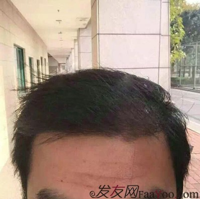 來山東青島植發(fā)2200毛囊單位，終于對(duì)我的發(fā)際線滿意了