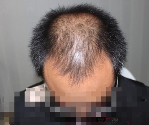 大麥微針植發(fā)3500單位，7個小時后我重拾年輕的心